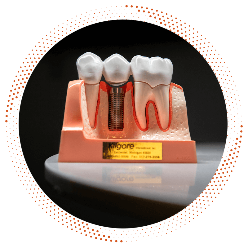 dental implants real